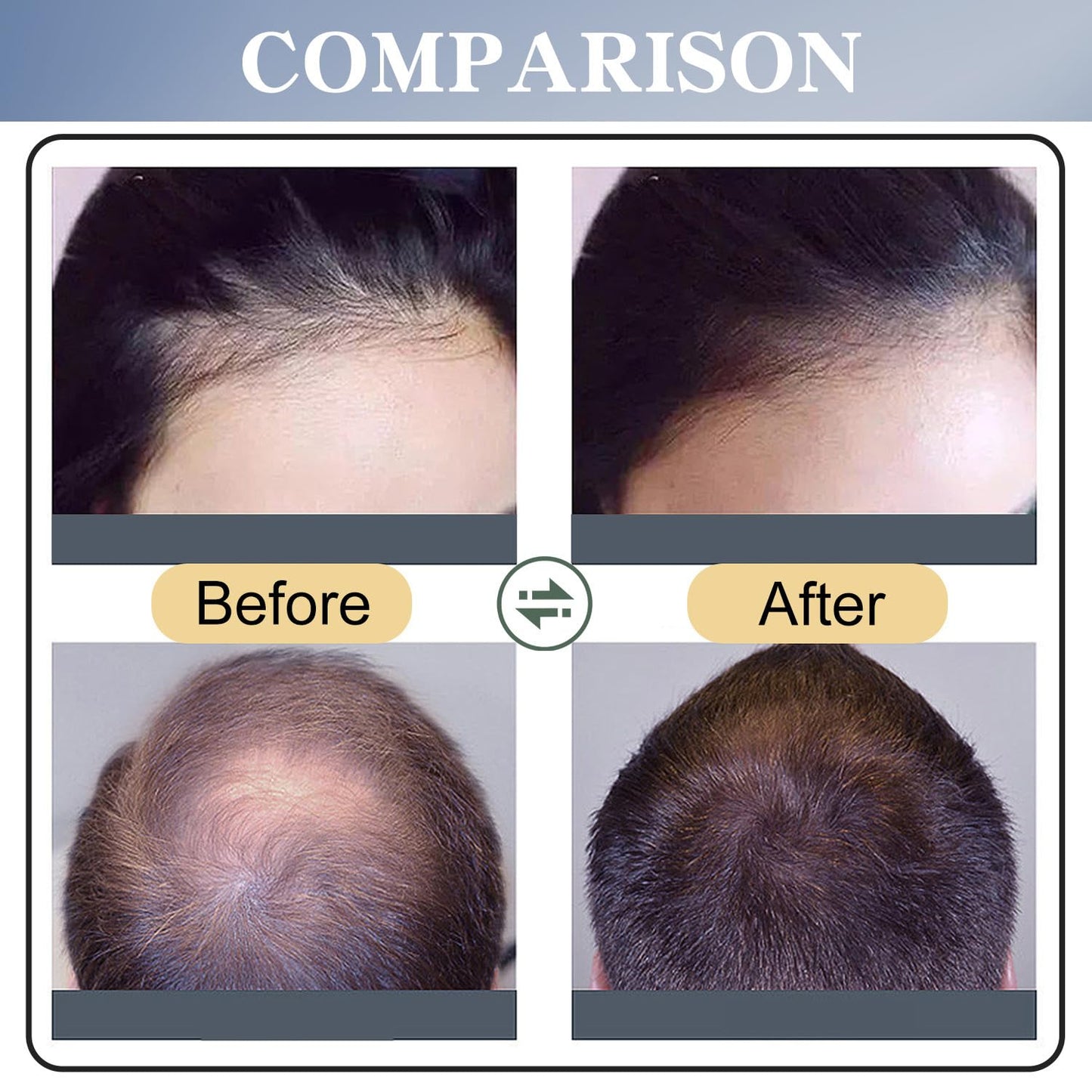 Minoxidil Hair Growth Spray Hair Growth Spray. Anti-Hair Loss, Stops Hair Thinning, Boosts Hair Strength And Thickens Hair, Treatment Spray